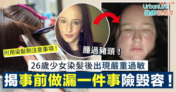 【染髮過敏】26歲少女染髮後出現嚴重過敏「腫過豬頭」
